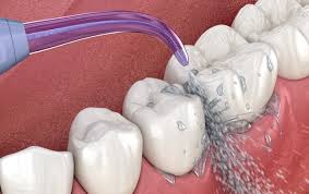 IRRIGADOR DENTAL
